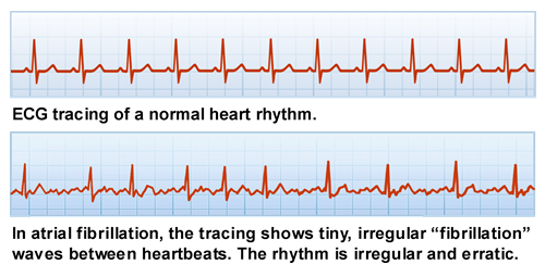 What is Atrial Fibrillation (AF)?