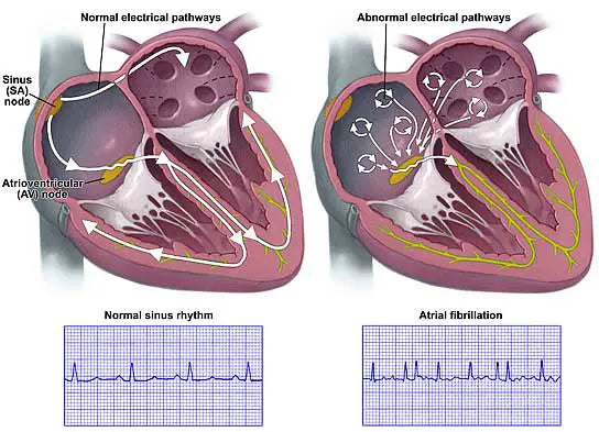 Is Atrial Fibrillation dangerous.? | Cardiac X