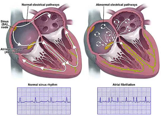 Is Atrial Fibrillation dangerous.?