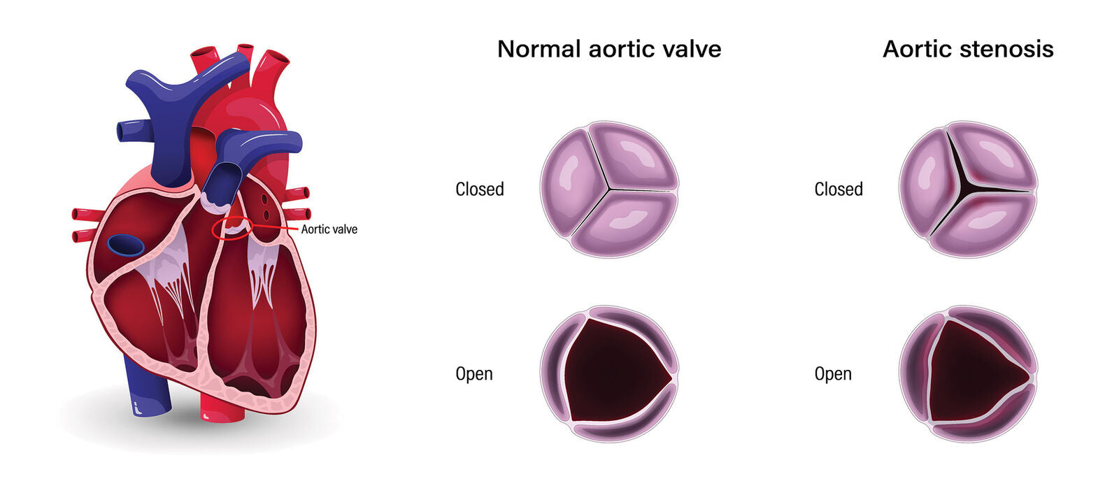 What is Aortic Stenosis? | Cardiac X