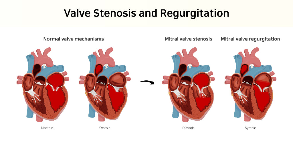 What is the difference between Mitral Regurgitation and Mitral Stenosis?