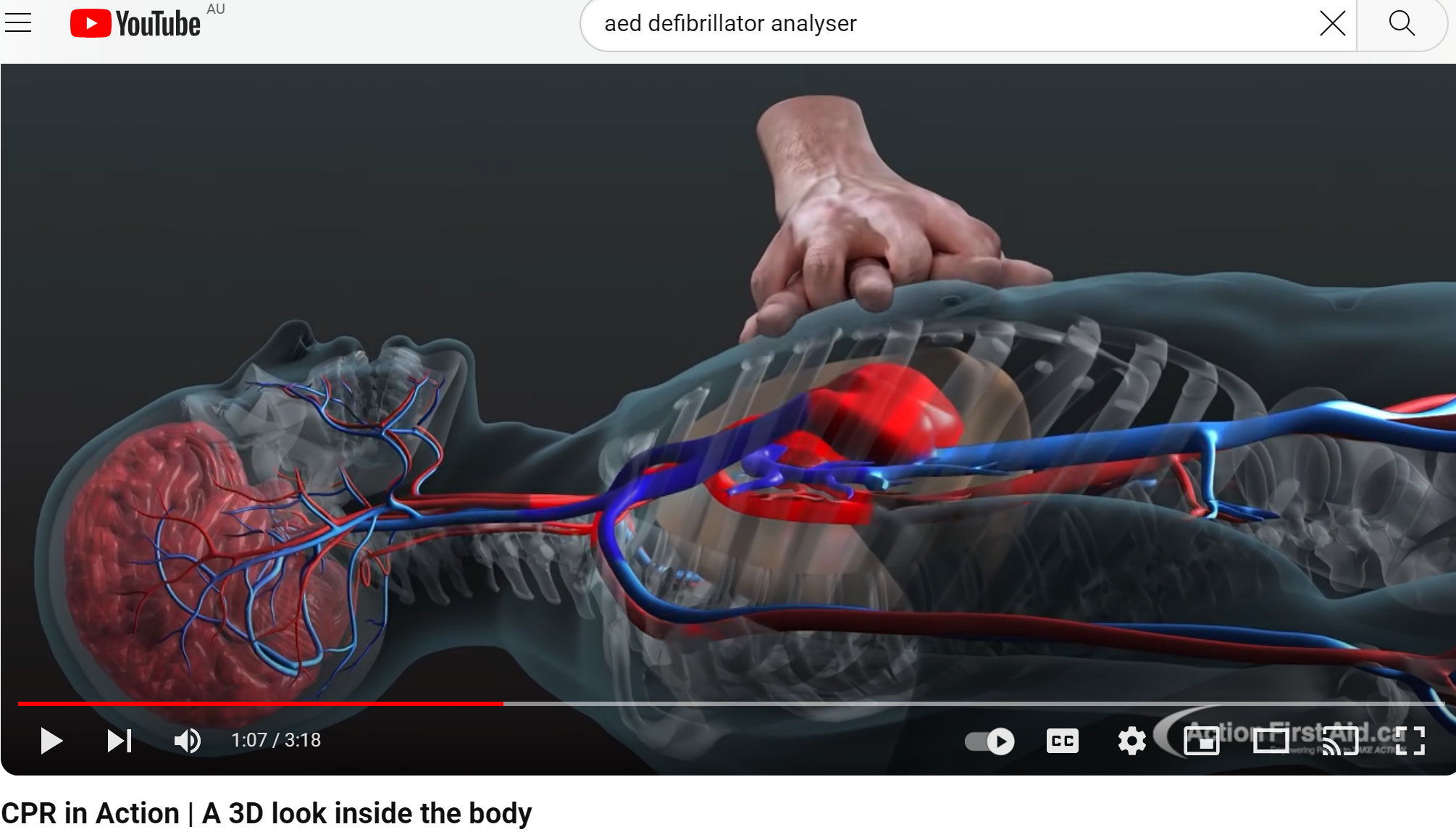 CPR in action, a 3D look inside the body. – Cardiac X