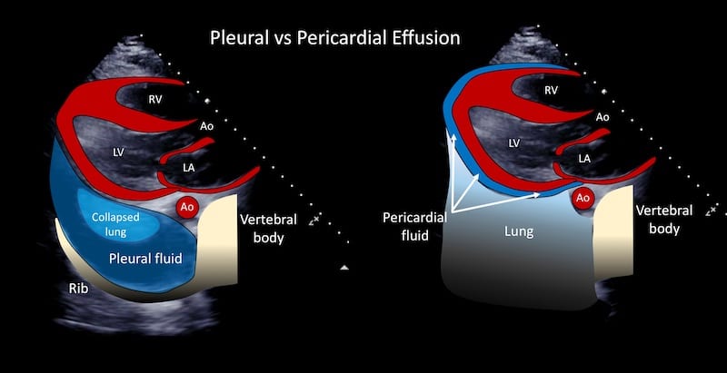 Plural & Pericardial Effusion | What are they?