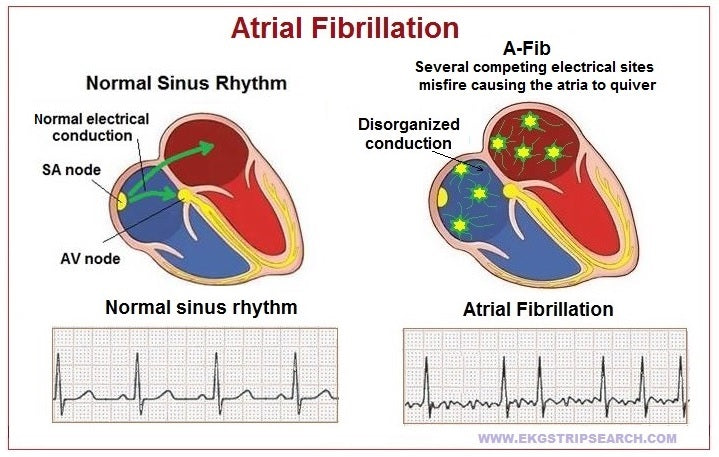 What is the difference between Atrial Fibrillation and Atrial Flutter ...