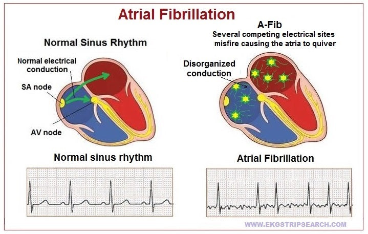 What Is The Difference Between Atrial Fibrillation And Atrial Flutter