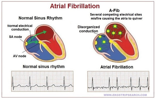 What is the difference between Atrial Fibrillation and Atrial Flutter?