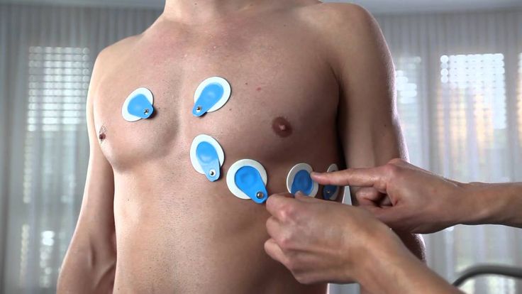 What are ECG Electrodes?