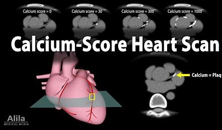 What is a CT Calcium score?