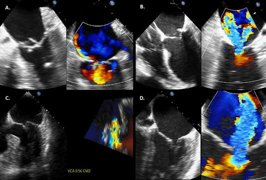 What is the difference between Aortic Regurgitation and Aortic Stenosis?