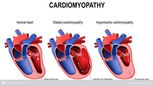 cardiomypathy diagram